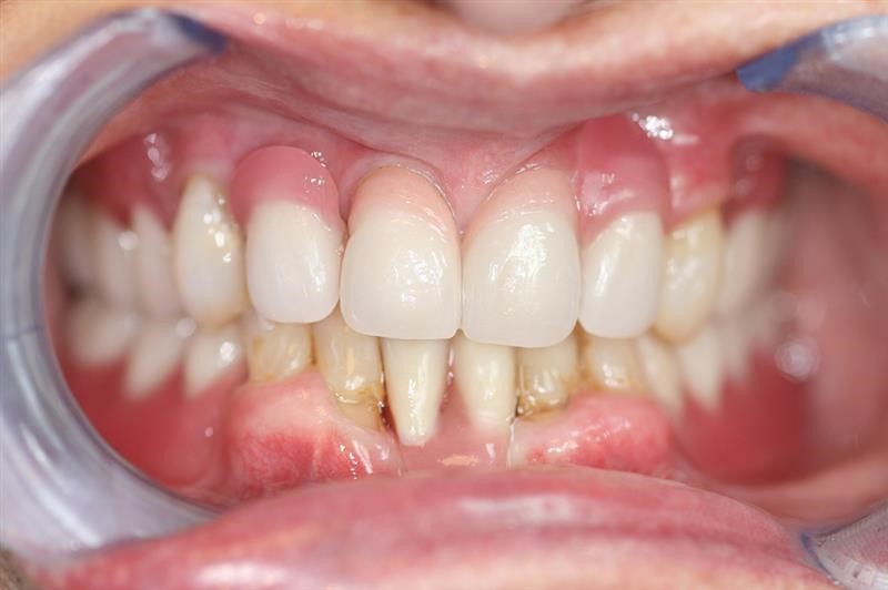 Upper Dentures Before And After Pictures Twin Bridges CA 95735